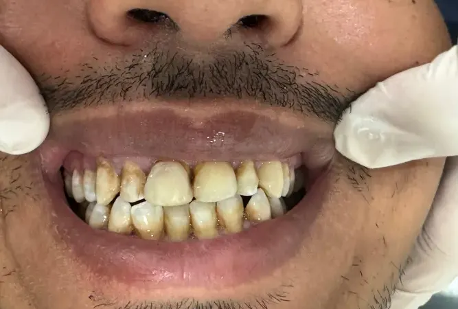 Antes del tratamiento dental