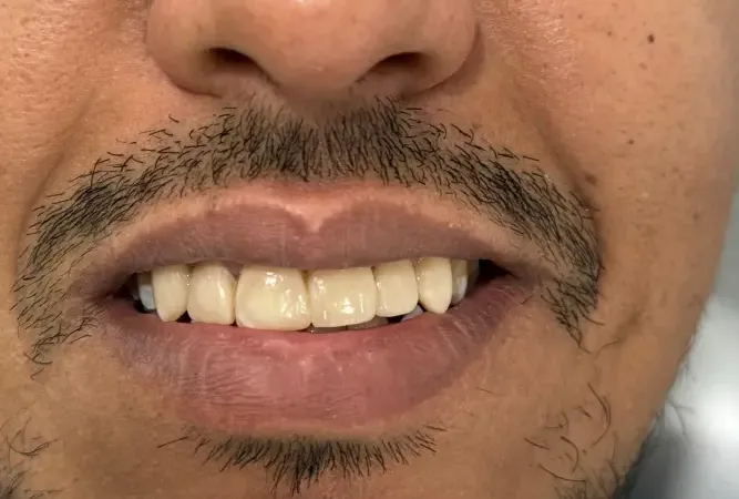 Después del tratamiento dental