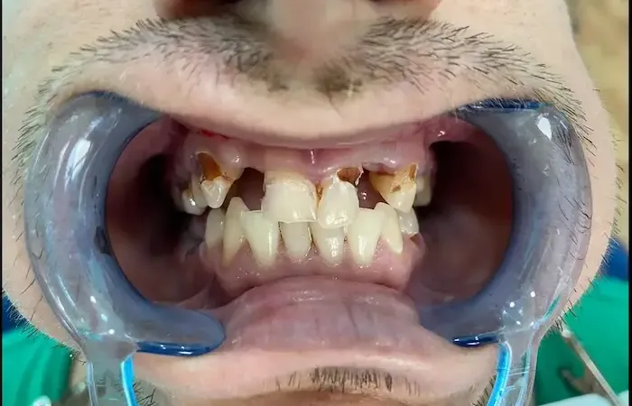 Antes del tratamiento dental