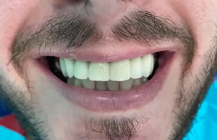 Después del tratamiento dental