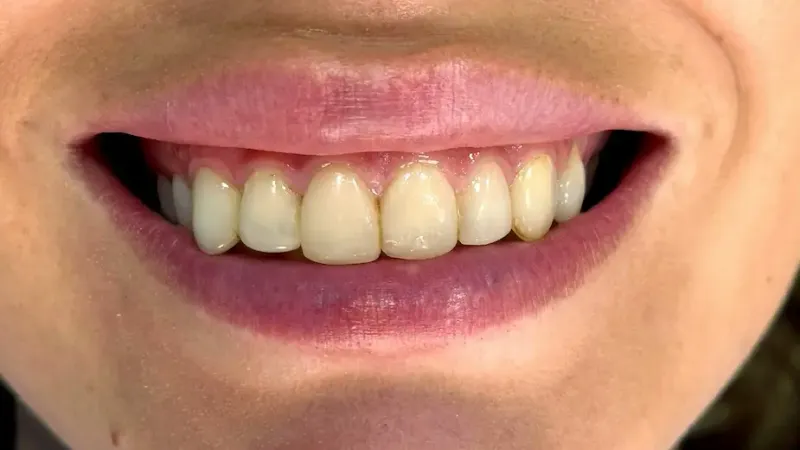 Antes del tratamiento dental