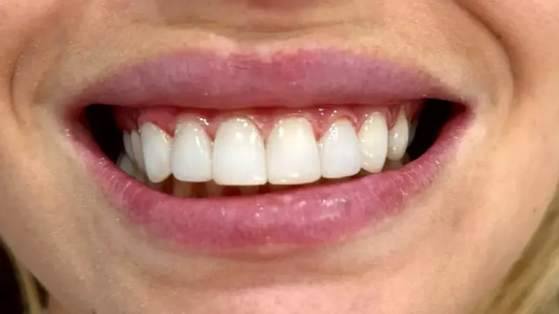 Después del tratamiento dental