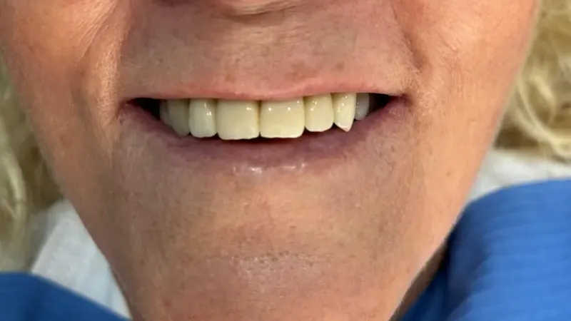 Después del tratamiento dental