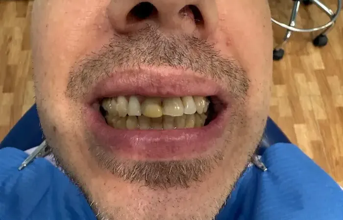 Antes del tratamiento dental