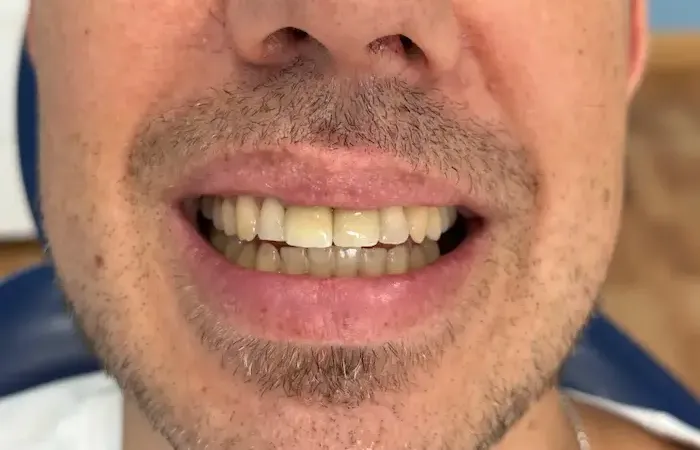 Después del tratamiento dental