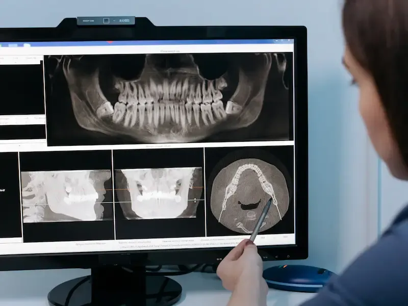 Equipo de radiografía Equipo de radiografía digital para diagnóstico preciso